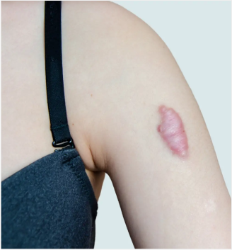 Keloid-Scars
