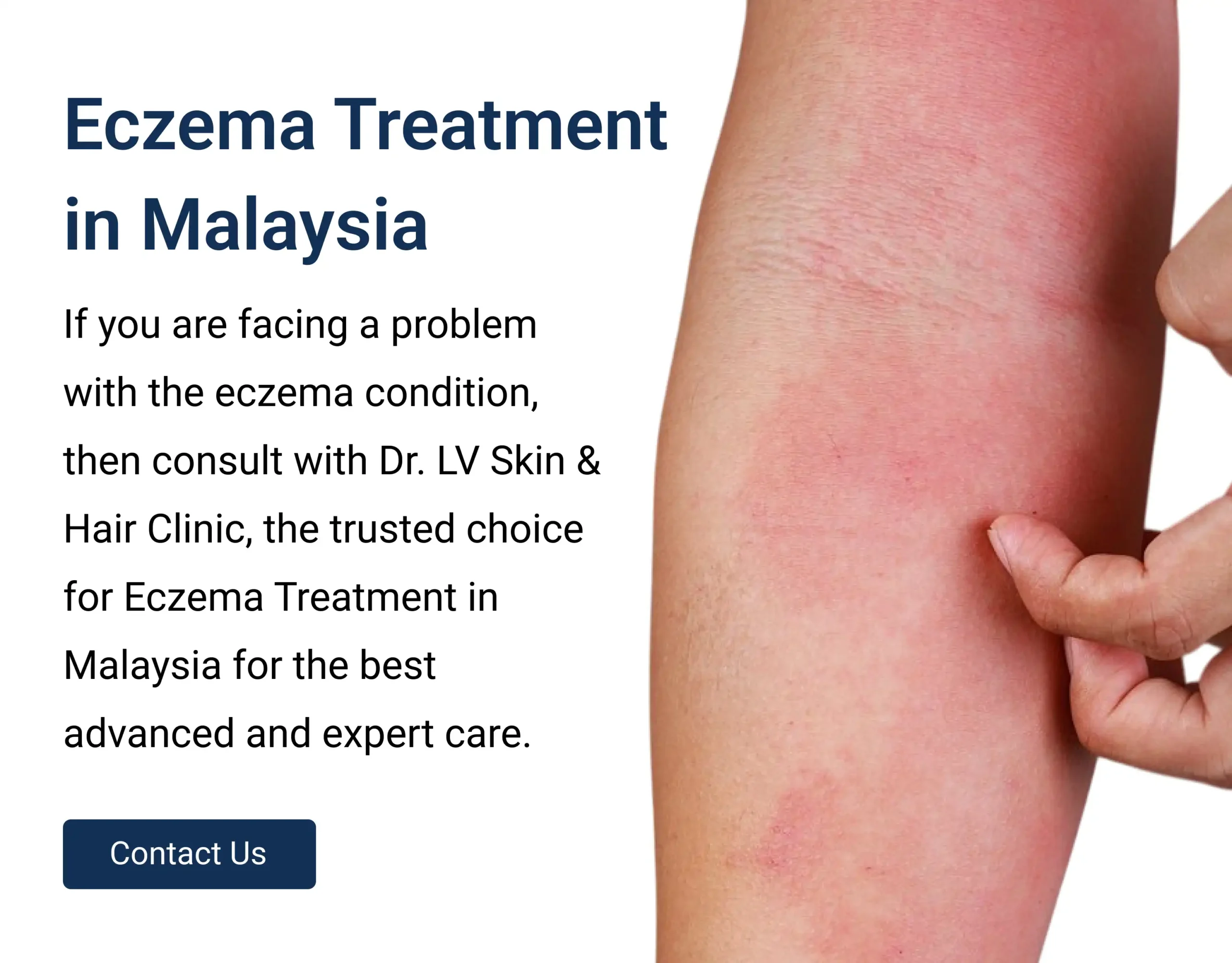 Eczema-Treatment-in-Malaysia