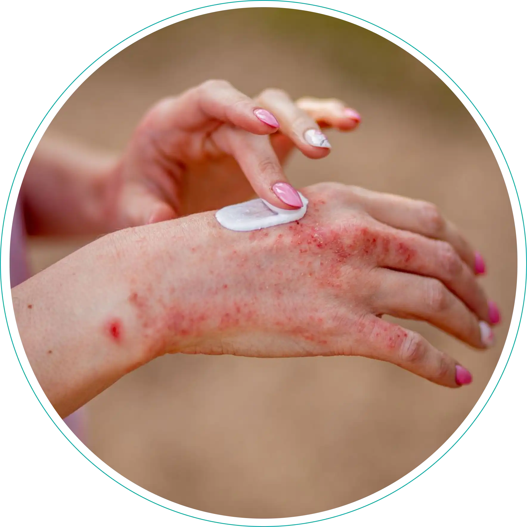 Eczema Treatment